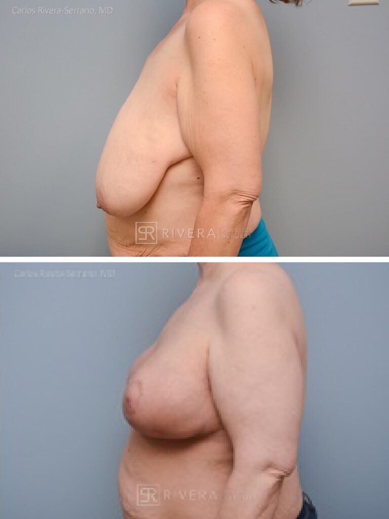 Left breast cancer. Oncoplastic breast reduction: This cancer was removed while performing a simultaneous bilateral breast reduction. - Woman - Case 26302 - Before and after - Lateral view