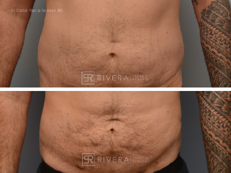 Mini Tummy Tuck Before & After Photos Fort Lauderdale, Coral Springs