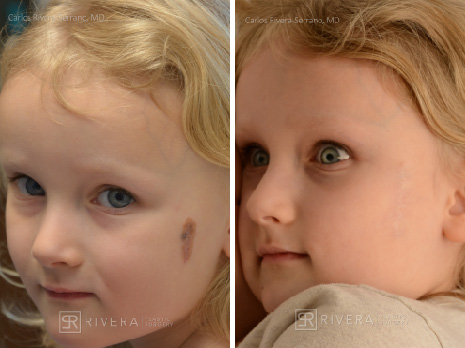 Removal (excision) of cheek congenital nevus - Girl - Case 8601 - Before and after - Oblique view