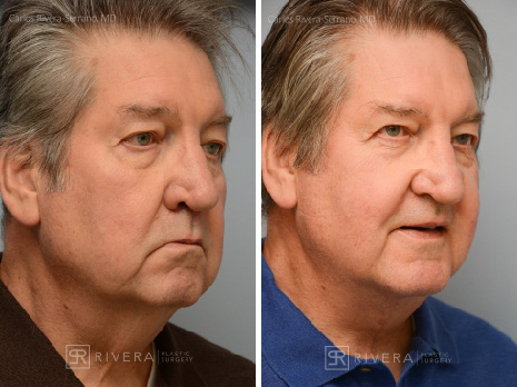 Neck lift, chin augmentation with implant - Man - Case 12102 - Before and after - Oblique view