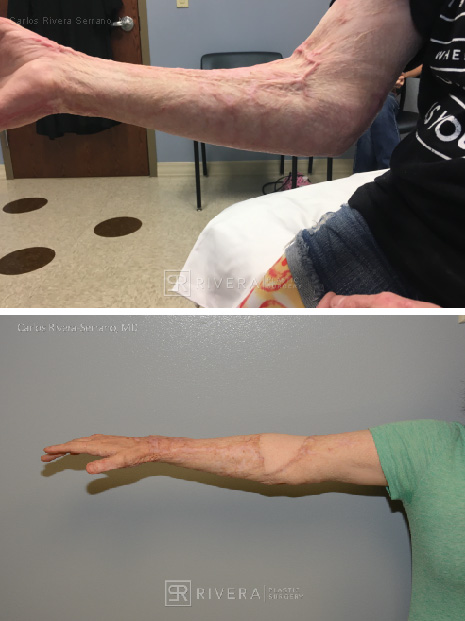 Right antecubital fossa reconstruction (contracture from burn injury) with ALT free flap (the patient could not straighten the arm prior to surgery) - Woman - Case 8901 - Before and after - Frontal view