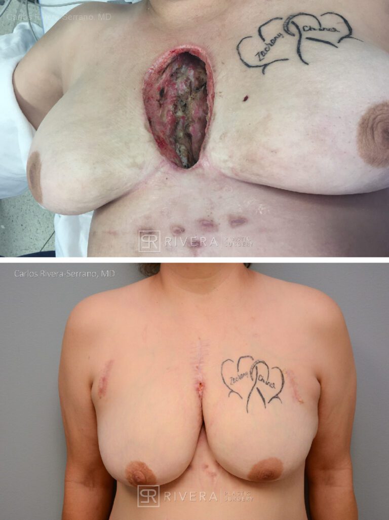 Chest wound reconstruction with pectoralis major flaps - Woman - Case 8902 - Before and after - Frontal view