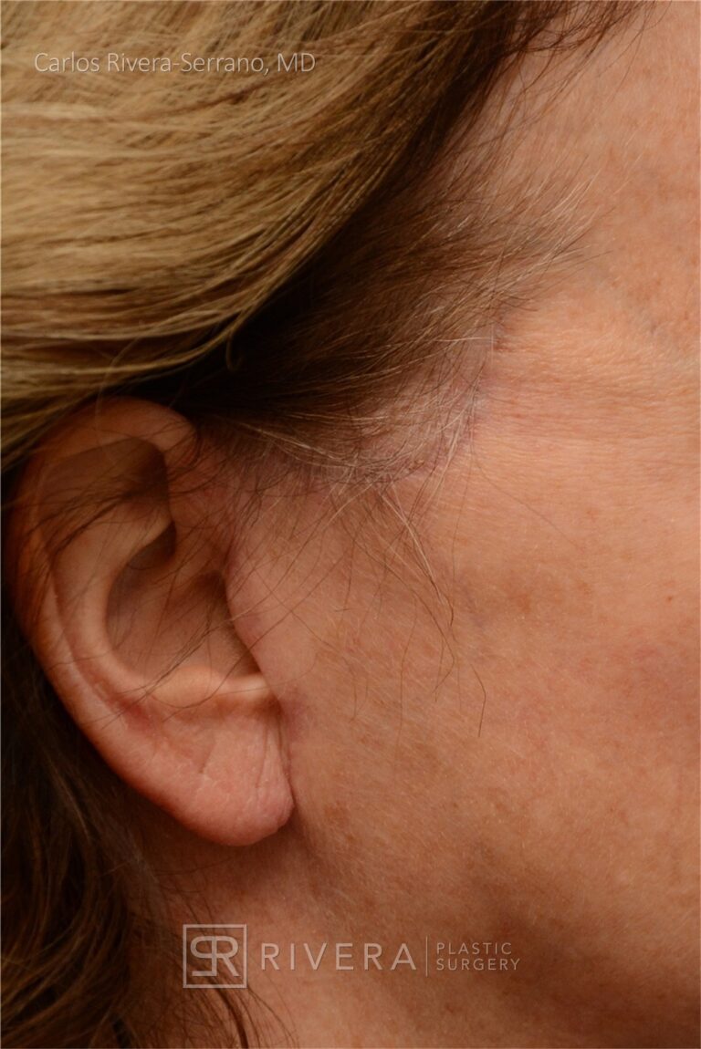 Facelift, chin augmentation with implant - Woman - Case 11104 - After surgery - Profile View