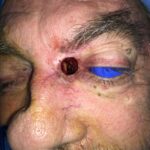 Left medial canthus reconstruction from skin cancer removal with Bilobed rotational flap - Man - Case 15409 - Intraoperative - Oblique view