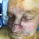Nose reconstruction from skin cancer removal with Burow's Triangle Displacement flap - Man - Case 16522 - Intraoperative - Oblique view