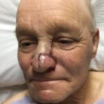 Nose reconstruction from skin cancer removal with Burow's Triangle Displacement flap - Man - Case 16522 - Intraoperative - Oblique view
