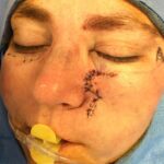 Cheek wound reconstruction from skin cancer removal with Burow's Triangle Displacement flaps - Woman - Case 111215 - Intraoperative - Frontal view