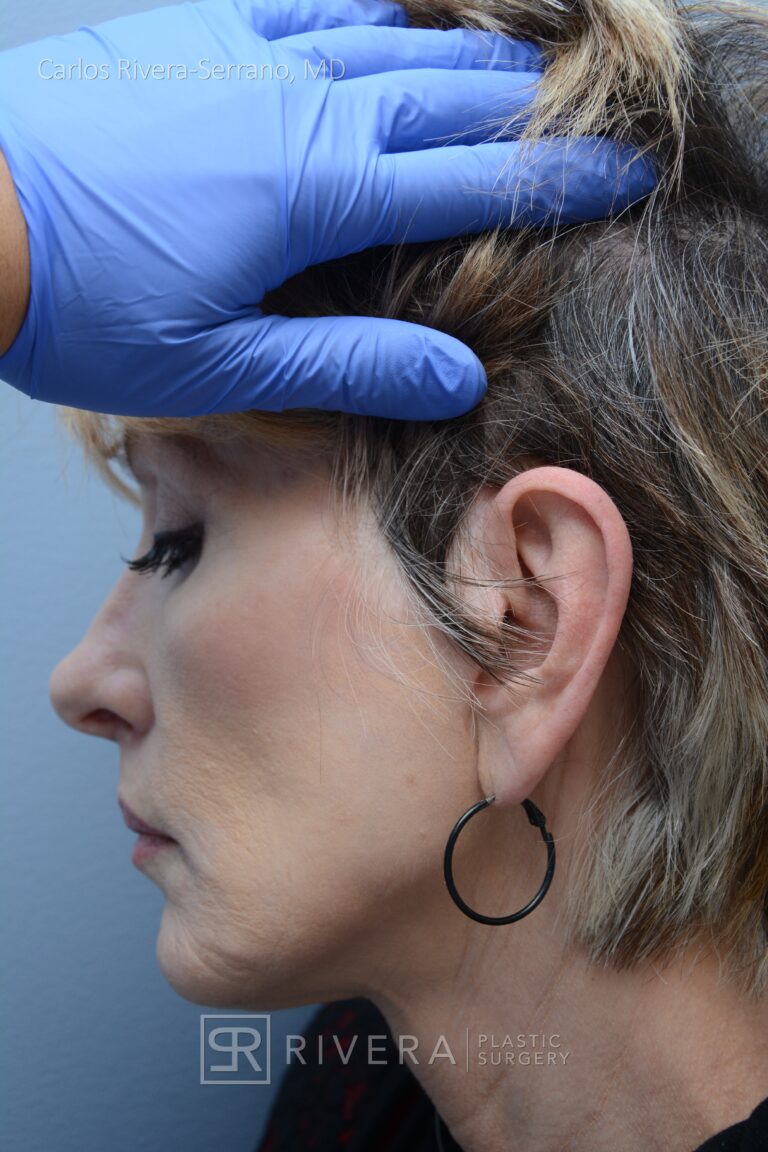 Short scar facelift (mini facelift), fat transfer (grafting) to the face, & TCA peel - Woman - Case 11101 - After surgery - Profile view