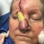 Nose reconstruction from skin cancer removal with Paramedian Forehead flap - Woman - Case 16504 - Woman - Intraoperative - Frontal view
