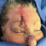 Nose reconstruction from skin cancer removal with Paramedian Forehead flap - Woman - Case 16504 - Woman - Intraoperative - Oblique view