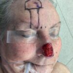 Nose reconstruction from skin cancer removal with Paramedian Forehead flap - Woman - Case 16504 - Woman - Intraoperative - Oblique view