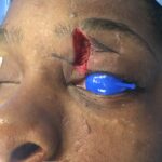Left upper eyelid retraction with exposed globe correction with Z Plasty - Woman- Case 15402 - Intraoperative - Oblique view