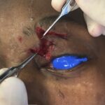 Left upper eyelid retraction with exposed globe correction with Z Plasty - Woman- Case 15402 - Intraoperative - Oblique view