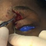 Left upper eyelid retraction with exposed globe correction with Z Plasty - Woman- Case 15402 - Intraoperative - Frontal view