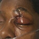 Left upper eyelid retraction with exposed globe correction with Z Plasty - Woman - Case 15402 - Intraoperative - Oblique view