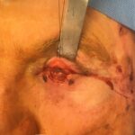 Left lower eyelid reconstruction from skin cancer with Hughes tarsoconjunctival flap & skin advancement flap - Man - Case 15403 - Intraoperative - Frontal view