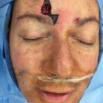 Forehead reconstruction from skin cancer removal with Burow's Triangle Displacement flap - Woman - Case 15410 - Intraoperative - Frontal view