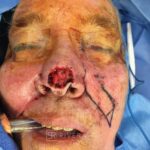 Nasal reconstruction from skin cancer removal with Melolabial flap - Woman - Case 16524 - Intraoperative - Frontal view