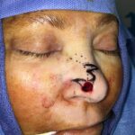 Nasal reconstruction from skin cancer removal with Bilobed Rotational flap - Woman - Case 16534 - Intraoperative - Oblique view