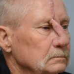 Nasal reconstruction from skin cancer removal with Paramedian Forehead flap - Man - Case 16529 - Postoperative - Oblique view