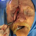 Cheek wound reconstruction from skin cancer removal with Paramedian forehead flap & cheek advacement flap - Man - Case 11127 - Intraoperative - Frontal view