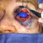 Left lower eyelid reconstruction from skin cancer with Hughes tarsoconjunctival flap & skin graft - Woman - Case 15405 - Intraoperative - Frontal view