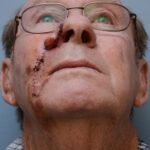 Nose reconstruction from skin cancer removal with Melolabial flap - Man - Case 16508 - Intraoperative - Inferior view