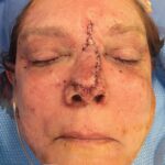 Nose reconstruction from skin cancer removal with Dorsal Sliding Advancement flap - Woman - Case 16509 - Intraoperative - Frontal view