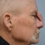 Nasal reconstruction from skin cancer removal with Paramedian Forehead flap - Man - Case 16529 - Postoperative - Frontal view