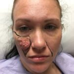 Removal of cheek birthmark and reconstruction with large Cervicofacial flap - Woman - Case 11121 - Preoperative - Frontal view