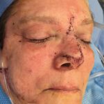 Nose reconstruction from skin cancer removal with Dorsal Sliding Advancement flap - Woman - Case 16509 - Intraoperative - Oblique view