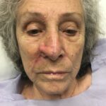 Nasal reconstruction from skin cancer removal with Melolabial flap - Woman - Case 16526 - Postoperative - Frontal view