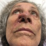 Nasal reconstruction from skin cancer removal with Melolabial flap - Woman - Case 16526 - Postoperative - Inferior view