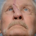 Nasal reconstruction from skin cancer removal with Paramedian Forehead flap - Man - Case 16529 - Postoperative - Interior view