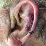 Left ear reconstruction from skin cancer removal (Cutaneous Horn)with Post Auricular flap (2 stages) - Man - Case 17302 - Intraoperative - Lateral view