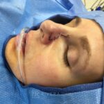 Nose reconstruction from skin cancer removal with Bilobed Rotational flap - Woman - Case 16510 - Intraoperative - Lateral view