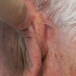 Left ear reconstruction from skin cancer removal (Cutaneous Horn)with Post Auricular flap (2 stages) - Man - Case 17302 - Postoperative - Lateral view