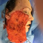 Removal of cheek birthmark and reconstruction with large Cervicofacial flap - Woman - Case 11121 - Intraoperative - Profile view