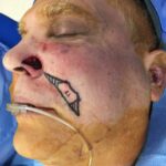 Nose reconstruction from skin cancer removal with Melolabial flap - Man - Case 16513 - Intraoperative- Oblique view
