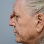 Nose reconstruction from skin cancer removal with Paramedian Forehead flap Miami- Woman - Case 16503 - Postoperative - Lateral view