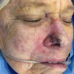 Nasal reconstruction from skin cancer removal with Melolabial flap - Woman - Case 16525 - Preoperative - Oblique view
