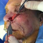 Nose reconstruction from skin cancer removal with Melolabial flap - Man - Case 16513 - Intraoperative- Oblique view