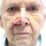 Nasal reconstruction from skin cancer removal with Melolabial flap - Woman - Case 16525 - Postoperative - Oblique view