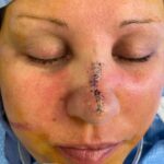 Nose reconstruction from skin cancer removal with Burow's Triangle Displacement flap - Woman - Case 16511 - Intraoperative - Frontal view