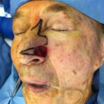 Nose reconstruction from skin cancer removal with Bilobed Rotational flap Miami - Man - Case 16512 - Intraoperative - Oblique view