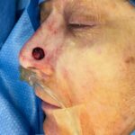 Nose reconstruction from skin cancer removal with Bilobed Rotational flap - Woman - Case 16516 - Intraoperative - Oblique view