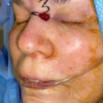 Nose reconstruction from skin cancer removal with Bilobed Rotational flap Miami- Woman - Case 16517 - Intraoperative - Oblique view