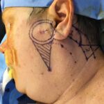 Cheek wound reconstruction from skin cancer removal with large Cervicofacial flap - Woman - Case 11123 - Intraoperative - Lateral view