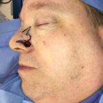 Nasal reconstruction from skin cancer removal with Bilobed Rotational flap - Man - Case 16532 - Intraoperative - Lateral view