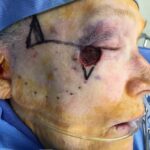 Cheek - lower eyelid wound reconstruction from skin cancer removal with Burow's Triangle Displacement Flap - Woman - Case 11129 - Intraoperative - Lateral view